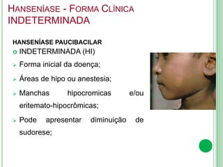 HANSENÍASE - FORMA CLÍNICA
INDETERMINADA
HANSENÍASE PAUCIBACILAR
 INDETERMINADA (HI)
 Forma inicial da doença;
 Áreas de hipo ou anestesia;
 Manchas hipocromicas e/ou
eritemato-hipocrômicas;
 Pode apresentar diminuição de
sudorese;
 