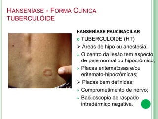 HANSENÍASE - FORMA CLÍNICA
TUBERCULÓIDE
HANSENÍASE PAUCIBACILAR
 TUBERCULOIDE (HT)
 Áreas de hipo ou anestesia;
 O centro da lesão tem aspecto
de pele normal ou hipocrômico;
 Placas eritematosas e/ou
eritemato-hipocrômicas;
 Placas bem definidas;
 Comprometimento de nervo;
 Baciloscopia de raspado
intradérmico negativa.
 