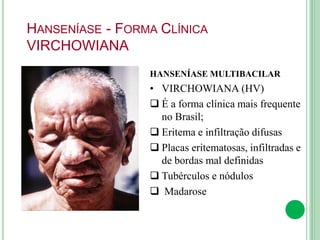HANSENÍASE - FORMA CLÍNICA
VIRCHOWIANA
HANSENÍASE MULTIBACILAR
• VIRCHOWIANA (HV)
 É a forma clínica mais frequente
no Brasil;
 Eritema e infiltração difusas
 Placas eritematosas, infiltradas e
de bordas mal definidas
 Tubérculos e nódulos
 Madarose
 