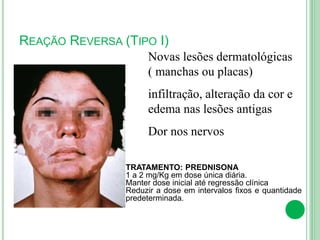 REAÇÃO REVERSA (TIPO I)
Novas lesões dermatológicas
( manchas ou placas)
infiltração, alteração da cor e
edema nas lesões antigas
Dor nos nervos
TRATAMENTO: PREDNISONA
1 a 2 mg/Kg em dose única diária.
Manter dose inicial até regressão clínica
Reduzir a dose em intervalos fixos e quantidade
predeterminada.
 