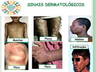 SINAIS DERMATOLÓGICOS
Nódulos
Infiltrações
Placa
Placas
Placa
Manchas
 