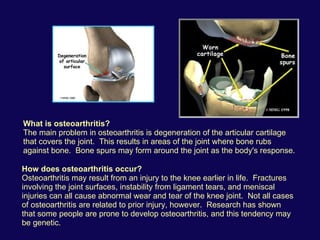 What is osteoarthritis? The main problem in osteoarthritis is degeneration of the articular cartilage that covers the joint.  This results in areas of the joint where bone rubs against bone.  Bone spurs may form around the joint as the body's response.    How does osteoarthritis occur? Osteoarthritis may result from an injury to the knee earlier in life.  Fractures involving the joint surfaces, instability from ligament tears, and meniscal injuries can all cause abnormal wear and tear of the knee joint.  Not all cases of osteoarthritis are related to prior injury, however.  Research has shown that some people are prone to develop osteoarthritis, and this tendency may be genetic.                                                                                       