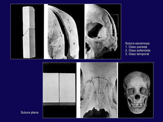 Sutura escamosa 1. Osso parietal 2. Osso esfenóide 3. Osso temporal Sutura plana 