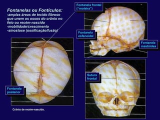 Sutura  frontal Fontanela  posterior Crânio de recém-nascido. Fontanelas ou Fontículos: -amplas áreas de tecido fibroso que unem os ossos do crânio no  feto ou recém-nascido -mobilidade/crescimento -sinostose (ossificação/fusão) Fontanela frontal (“moleira”) Fontanela  esfenoidal Fontanela  mastóidea 