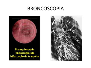 BRONCOSCOPIA
 