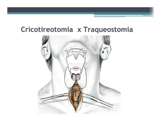 Cricotireotomia x Traqueostomia
 