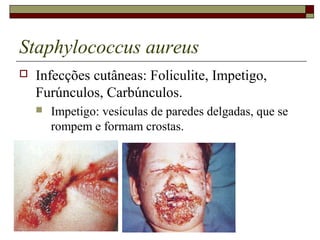 Staphylococcus aureus
 Infecções cutâneas: Foliculite, Impetigo,
Furúnculos, Carbúnculos.
 Impetigo: vesículas de paredes delgadas, que se
rompem e formam crostas.
 