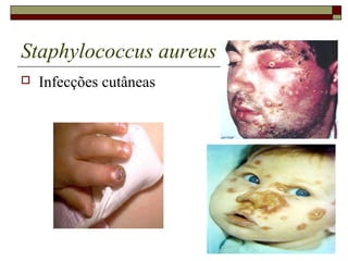 Staphylococcus aureus
 Infecções cutâneas
 