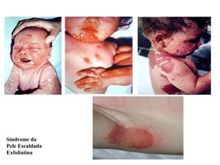 Síndrome da
Pele Escaldada
Exfoliatina
 