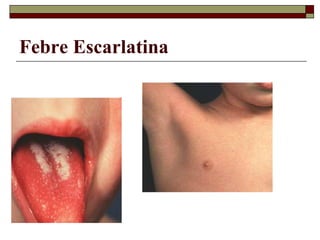Febre Escarlatina
 