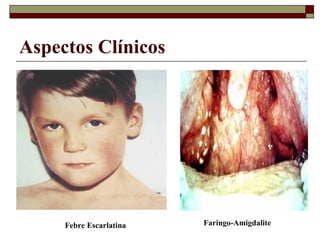 Aspectos Clínicos
Faringo-AmigdaliteFebre Escarlatina
 