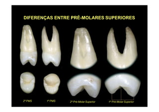 DIFERENÇAS ENTRE PRÉ-MOLARES SUPERIORES
2º Pré-Molar Superior2º PMS 1º PMS 1º Pré-Molar Superior
 