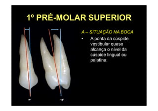 1º PRÉ-MOLAR SUPERIOR
A – SITUAÇÃO NA BOCA
• A ponta da cúspide
vestibular quase
alcança o nível da
cúspide lingual ou
palatina;
 