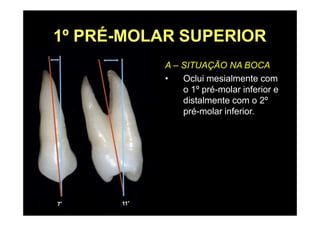 1º PRÉ-MOLAR SUPERIOR
A – SITUAÇÃO NA BOCA
• Oclui mesialmente com
o 1º pré-molar inferior e
distalmente com o 2º
pré-molar inferior.
 