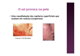 O sol provoca na pele
Uma vasodilatação dos capilares superficiais que
acabam em rosácea (couperose)
 