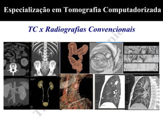 Especialização em Tomografia Computadorizada

      TC x Radiografias Convencionais
 