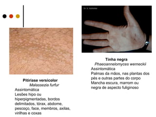 Tinha negra
Phaeoannelomyces werneckii
Assintomática
Palmas da mãos, nas plantas dos
pés e outras partes do corpo
Mancha escura, marrom ou
negra de aspecto fuliginoso
Pitiriase versicolor
Malassezia furfur
Assintomática
Lesões hipo ou
hiperpigmentadas, bordos
delimitados, tórax, abdome,
pescoço, face, membros, axilas,
virilhas e coxas
 