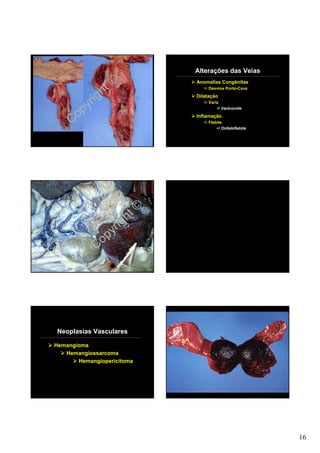 Alterações das Veias

               t©
                            Anomalias Congênitas

              h                  Desvios Porto-Cava

            ig              Dilatação

         yr                      Variz


       op
                                         Varicocele
                            Inflamação
     C                           Flebite
                                        Onfaloflebite




                      ht©
                    ig
                 yr
             C op




Neoplasias Vasculares

Hemangioma
   Hemangiossarcoma
       Hemangiopericitoma




                                                        16
 