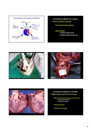 Complicações da Insuficiência Cardíaca
                                                                                 Anomalias Congênitas do Coração
                          Cérebro:                                               Desvio sistêmico pulmonar
                           Fluxo Sanguíneo: hipóxia

                                                      Pulmão:
 Fígado:                                               Congestão/Transudação:
                                                                Edema
                                                                                    Ducto Arterioso Persistente
   Pressão Portal
   Síntese de Proteínas                                Ventilação:
   Detoxificação                                                Dispnéia
                                                       Captação 02:
                                                                Cianose

                                                                                    Defeito Septal
                                                                                            Defeito Septal Atrial
                                                                                              Defeito Septal Ventricular
Musculatura Esquelética:                              Rim:
Metabolismo Anaeróbico:                                Filtração Glomerular
          Fadiga                                       Reabsorção de Na+
                                                      Retenção Água: Edema




          ht©
        ig
     yr
 C op




                                                                                 Anomalias Congênitas do Coração
                                                                                Malformações das Válvulas Cardíacas

                                                                                  Obstrução ao fluxo de saída ventricular direito
                                                                                         Estenose Pulmonar
                                                                                         Estenose Aórtica

                                                                                  Displasia de Mitral

                                                                                  Displasia de Tricúspide




                                                                                                                                    4
 