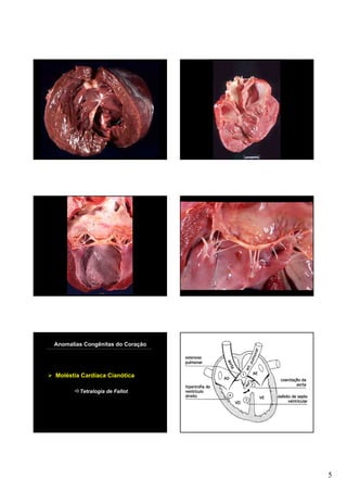 Anomalias Congênitas do Coração




Moléstia Cardíaca Cianótica

        Tetralogia de Fallot




                                  5
 