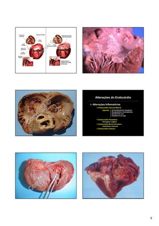 Ventrículo         Ventrículo Direito
                                                                 Distorção de Valvas
 Esquerdo
                                                                  Átrio-Ventriculares


                         Valva
                        A-V Dir

                                               ©
                                            ht
      Valva
     A-V Esq                                           Valvas


                                          g
                                          Átrio-Ventriculares

                                      i
                                    yr
    Valva A-V
    Esquerda


                                  p
                       Co
     Corda
   Tendinosa

Músculo
Papilar


                                                                Degeneração e
                                                                ruptura de cordas
                                                                tendinosas




                                                                                          Alterações do Endocárdio



                         ht©                                                            Alterações Inflamatórias
                                                                                            Endocardite (Valvular/Mural)


                       ig                                                                       Agentes     Arcanobacterium pyogenes



                    yr
                                                                                                             Erysipelothrix rhusiopathiae
                                                                                                             Escherichia coli



                  op
                                                                                                             Streptococcus spp

                                                                                            Endocardite Parasitária

                C                                                                                Strongylus vulgaris
                                                                                            Endocardite Mural Ulcerativa
                                                                                                 Clostridium chauvoei
                                                                                            Endocardite Urêmica




                          ht©
                        ig
                     yr
                 C op




                                                                                                                                            8
 