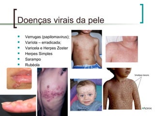 Doenças virais da pele
 Verrugas (papilomavirus);
 Varíola – erradicada;
 Varicela e Herpes Zoster
 Herpes Simples
 Sarampo
 Rubéola
 