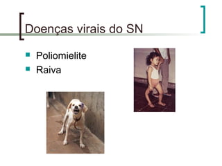 Doenças virais do SN
 Poliomielite
 Raiva
 
