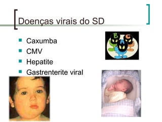 Doenças virais do SD
 Caxumba
 CMV
 Hepatite
 Gastrenterite viral
 