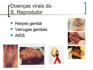 Doenças virais do
S. Reprodutor
 Herpes genital
 Verrugas genitais
 AIDS
 