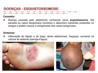 Causador:
Doença causada pelo platelminto conhecido como esquistossomo. Ele
parasita os vasos sanguíneos humanos e absorvem nutrientes presentes no
sangue e podem causar o entupimento dos vasos sanguíneos.
Sintomas:
Inflamação do fígado e do baço, dores abdominais, fraqueza, aumento no
volume do abdome (barriga-d’água).
 