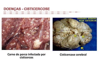 Carne de porco infectada por
cisticercos
Cisticercose cerebral
 