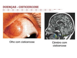 Olho com cisticercose Cérebro com
cisticercose
 