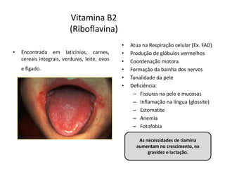 Vitamina B2
(Riboflavina)
• Encontrada em laticínios, carnes,
cereais integrais, verduras, leite, ovos
e fígado.
• Atua na Respiração celular (Ex. FAD)
• Produção de glóbulos vermelhos
• Coordenação motora
• Formação da bainha dos nervos
• Tonalidade da pele
• Deficiência:
– Fissuras na pele e mucosas
– Inflamação na língua (glossite)
– Estomatite
– Anemia
– Fotofobia
As necessidades de tiamina
aumentam no crescimento, na
gravidez e lactação.
 