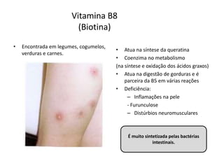 Vitamina B8
(Biotina)
• Encontrada em legumes, cogumelos,
verduras e carnes.
• Atua na síntese da queratina
• Coenzima no metabolismo
(na síntese e oxidação dos ácidos graxos)
• Atua na digestão de gorduras e é
parceira da B5 em várias reações
• Deficiência:
– Inflamações na pele
- Furunculose
– Distúrbios neuromusculares
É muito sintetizada pelas bactérias
intestinais.
 