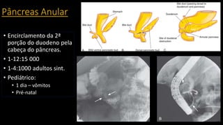 Pâncreas Anular
• Encirclamento da 2ª
porção do duodeno pela
cabeça do pâncreas.
• 1-12:15 000
• 1-4:1000 adultos sint.
• Pediátrico:
• 1 dia – vômitos
• Pré-natal
 