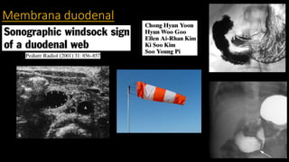 Membrana duodenal
 