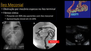 Íleo Meconial
• Obstrução por mecônio espesso no íleo terminal
• Fibrose cística
• Presente em 90% dos pacientes com íleo meconial
• Apresentação inicial em 15-20%
Neuhauser
 