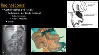 Íleo Meconial
• Complicações pré-natais:
• Perfuração – peritonite meconial
• Cistos meconiais
• Atresias intestinais
• Volvo
 