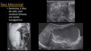 Íleo Meconial
• Feminino, 2 dias
de vida, com
resíduos biliosos
em sonda
nasogástrica
 
