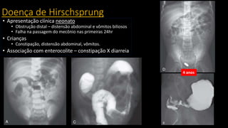 Doença de Hirschsprung
• Apresentação clínica neonato
• Obstrução distal – distensão abdominal e vômitos biliosos
• Falha na passagem do mecônio nas primeiras 24hr
• Crianças
• Constipação, distensão abdominal, vômitos.
• Associação com enterocolite – constipação X diarreia
4 anos
 