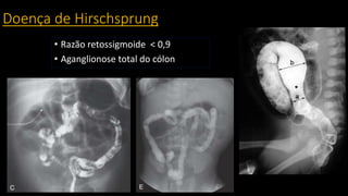 Doença de Hirschsprung
• Razão retossigmoide < 0,9
• Aganglionose total do cólon
 