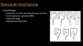 Doença de Hirschsprung
• Classificação
• Ultracurto: 4 cm do reto distal (tubo de enema)
• Curto segmento: sigmoide (80%)
• Segmento longo
• Aganglionose total cólon
 