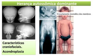 Herança autossômica dominante
Características
craniofaciais.
Acondroplasia
 