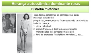 Distrofia miotônica
Herança autossômica dominante raras
Essa doença caracteriza-se por fraqueza e perda
muscular lentamente
progressiva, começando na face e causando característica
facial da doença:
1. ptose palpebral,
2. grande fraqueza e destruição dos músculos
mandibulares e es ternoclidomastoídeo,
3. falta de expressão facial (fácies miopática), etc ...
 