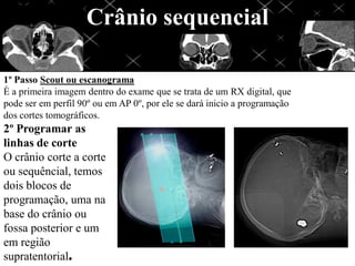 Crânio sequencial

1º Passo Scout ou escanograma
È a primeira imagem dentro do exame que se trata de um RX digital, que
pode ser em perfil 90º ou em AP 0º, por ele se dará inicio a programação
dos cortes tomográficos.
2º Programar as
linhas de corte
O crânio corte a corte
ou sequêncial, temos
dois blocos de
programação, uma na
base do crânio ou
fossa posterior e um
em região
supratentorial.
 