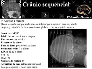 Crânio sequencial

3º Ajustar a técnica
Os cortes serão sempre realizados de inferior para superior, com angulação
do gantry ajustada de base do crânio a glabela, com as seguinte técnica:

Scout lateral 90º
Inicio dos cortes: forame magno
Fim dos cortes: vértice
Espessura de corte:
Base ou fossa posterior: 2 a 5mm
Supra tentorial: 7 a 10mm
F.O.V: de 22 a 25cm
kV: 130
mA: 170
Numero de cortes: 24
Algoritmo de reconstrução: Standard
Para parênquima e Bone para óssea.
 