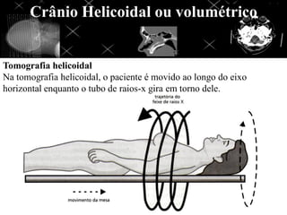 Crânio Helicoidal ou volumétrico


Tomografia helicoidal
Na tomografia helicoidal, o paciente é movido ao longo do eixo
horizontal enquanto o tubo de raios-x gira em torno dele.
 