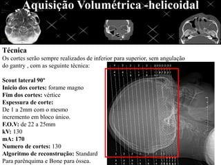 Aquisição Volumétrica -helicoidal


Técnica
Os cortes serão sempre realizados de inferior para superior, sem angulação
do gantry , com as seguinte técnica:

Scout lateral 90º
Inicio dos cortes: forame magno
Fim dos cortes: vértice
Espessura de corte:
De 1 a 2mm com o mesmo
incremento em bloco único.
F.O.V: de 22 a 25mm
kV: 130
mA: 170
Numero de cortes: 130
Algoritmo de reconstrução: Standard
Para parênquima e Bone para óssea.
 