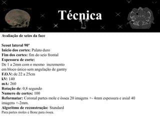 Técnica
Avaliação de seios da face

Scout lateral 90º
Inicio dos cortes: Palato duro
Fim dos cortes: fim do seio frontal
Espessura de corte:
De 1 a 2mm com o mesmo incremento
em bloco único sem angulação de gantry
F.O.V: de 22 a 25cm
kV: 140
mA: 260
Rotação de: 0,8 segundo
Numero de cortes: 100
Reformatar: Coronal partes mole e óssea 20 imagens +- 4mm espessura e axial 40
imagens +-2mm.
Algoritmo de reconstrução: Standard
Para partes moles e Bone para óssea.
 