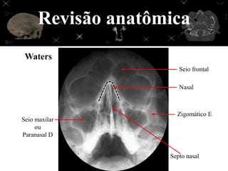 Revisão anatômica
 Waters
                       Seio frontal

                       Nasal



                      Zigomático E
Seio maxilar
     ou
Paranasal D


                    Septo nasal
 